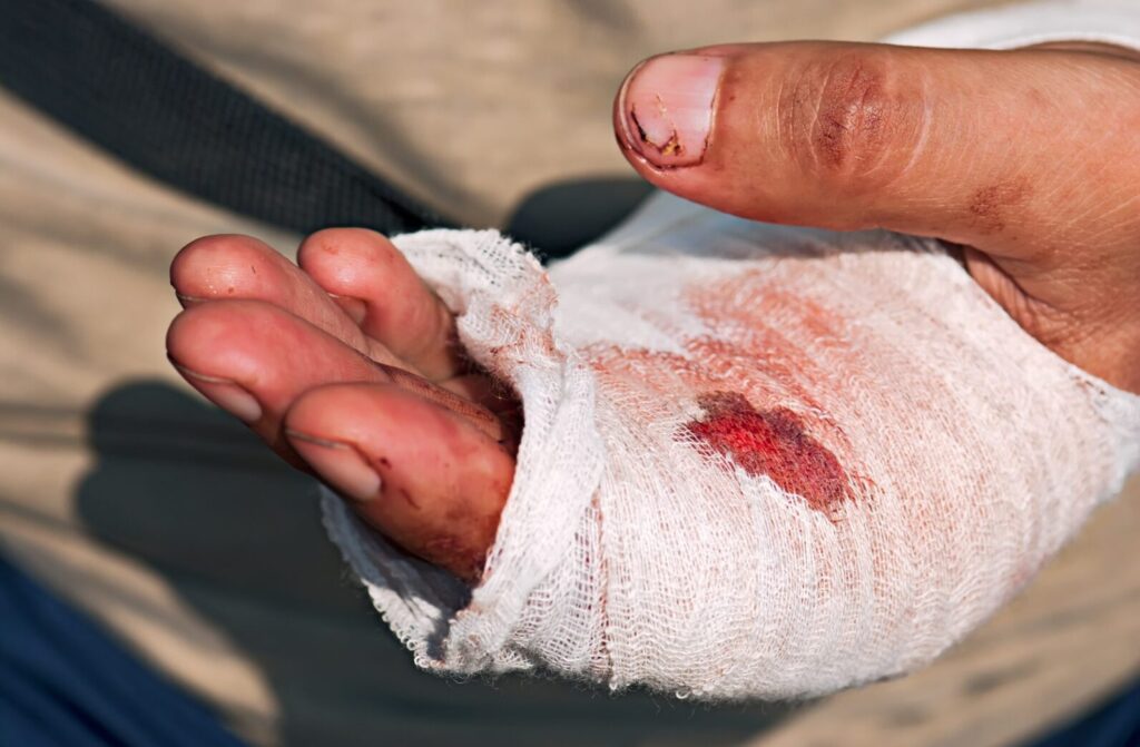 hand injury requiring urgent attention from work related accident